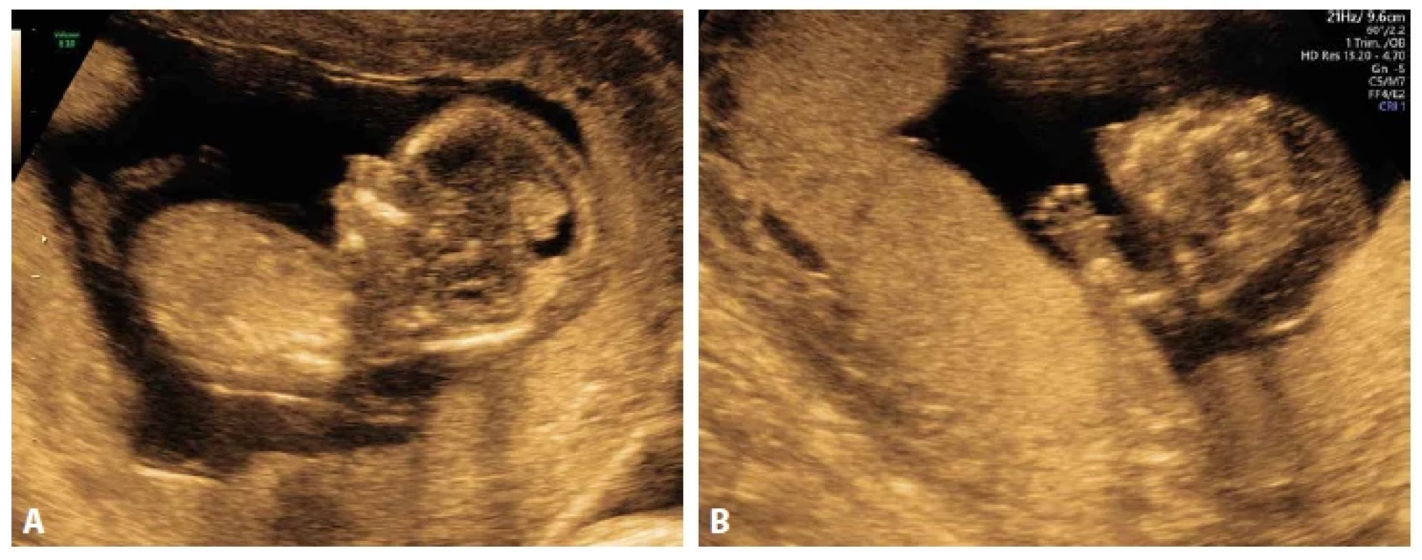 A: Atelosteogeneze typu 2, plod 13+0 týden, UZ. Hypoplázie dolní čelisti, hydrops. B: Stopařský palec.