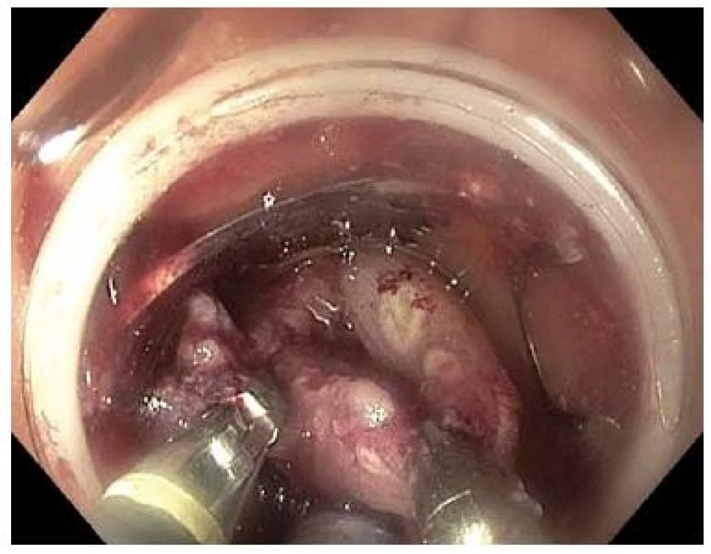 Zachycení LRN dvojicí kleští s použitím dvoukanálového endoskopu.<br> Fig. 7. Pulling the lesion by two graspers introduced through a double-channel endoscope.