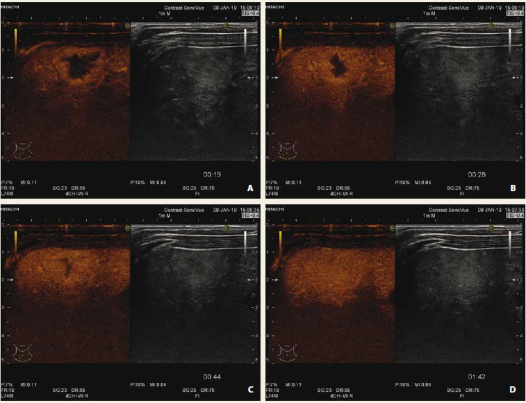 Hemangiom jater CEUS časná arteriální fáze (A), arteriální fáze (B), portální fáze (C), pozdní fáze (D). Typický patognomický
obraz centripetální nodulární opacifikace ložiska.<br>
Fig. 3. Liver haemangioma in early arterial phase (A), arterial phase (B), portal phase (C), late phase (D). Typical patognomical
sign of centripetal nodular opacification of lesion.