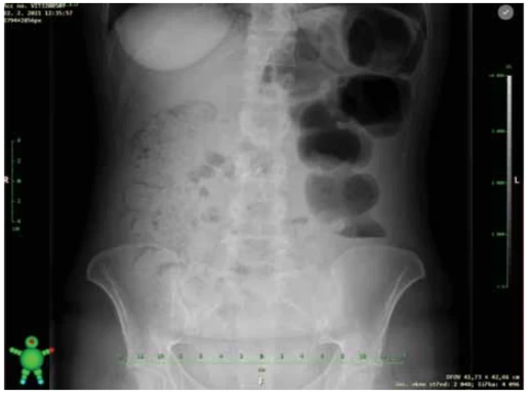 X-ray image of abdomen with ileus sign. <br> 
Obr. 2. Prostý rentgenový snímek břicha s nálezem ileózního stavu.