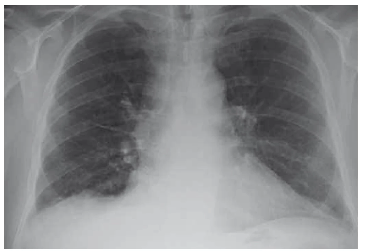 RTG plic po léčbě – nález v regres (10/2018).<br>
Fig. 4. Lung X-ray after treatement – regression (10/2018).