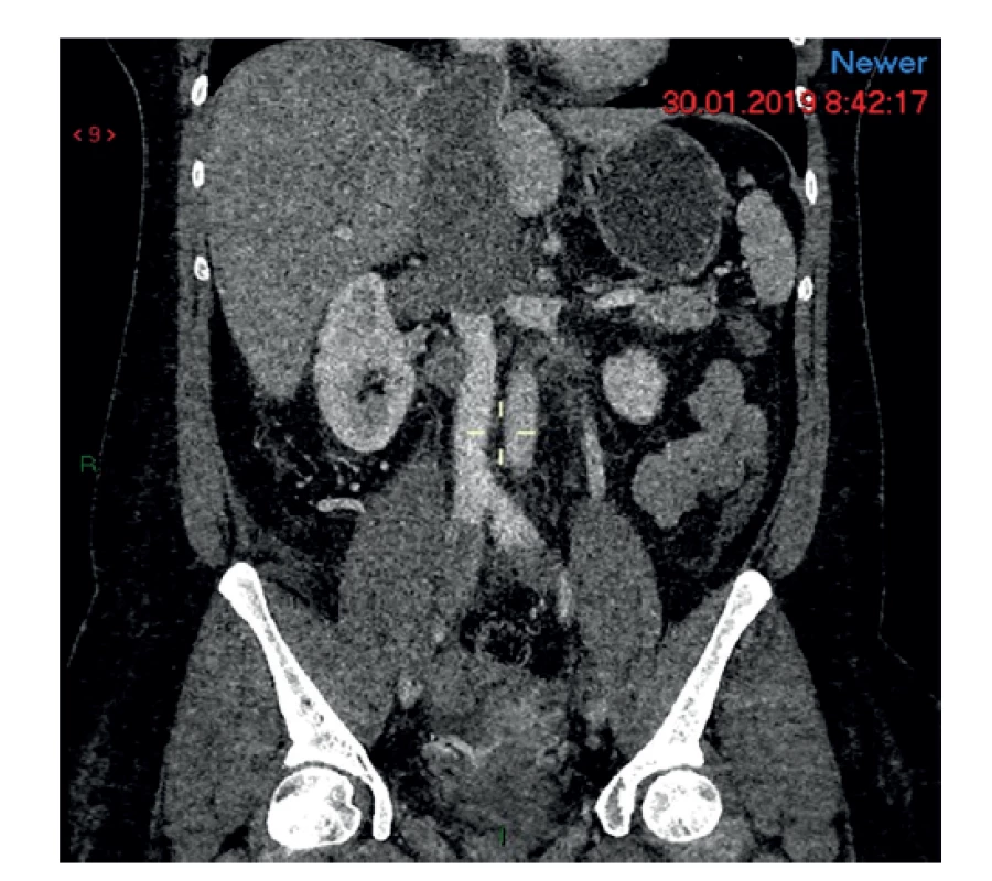Nádorový trombus vo vena cava inf.<br>
Fig. 3: Tumor thrombus in the inferior vena cava