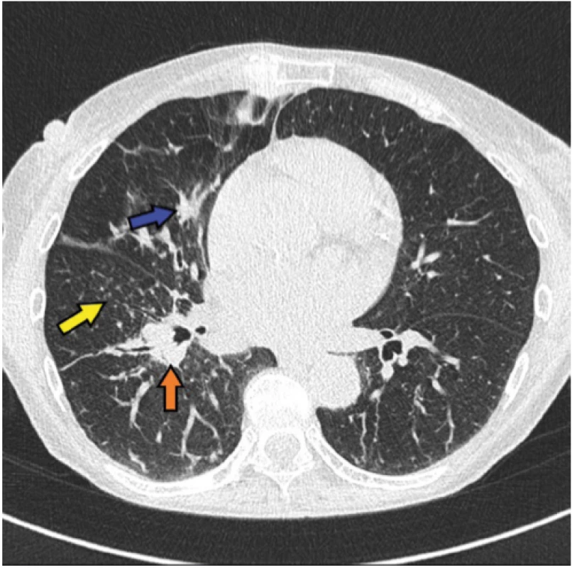  Radiologický obraz onemocnění – kazuistika 1