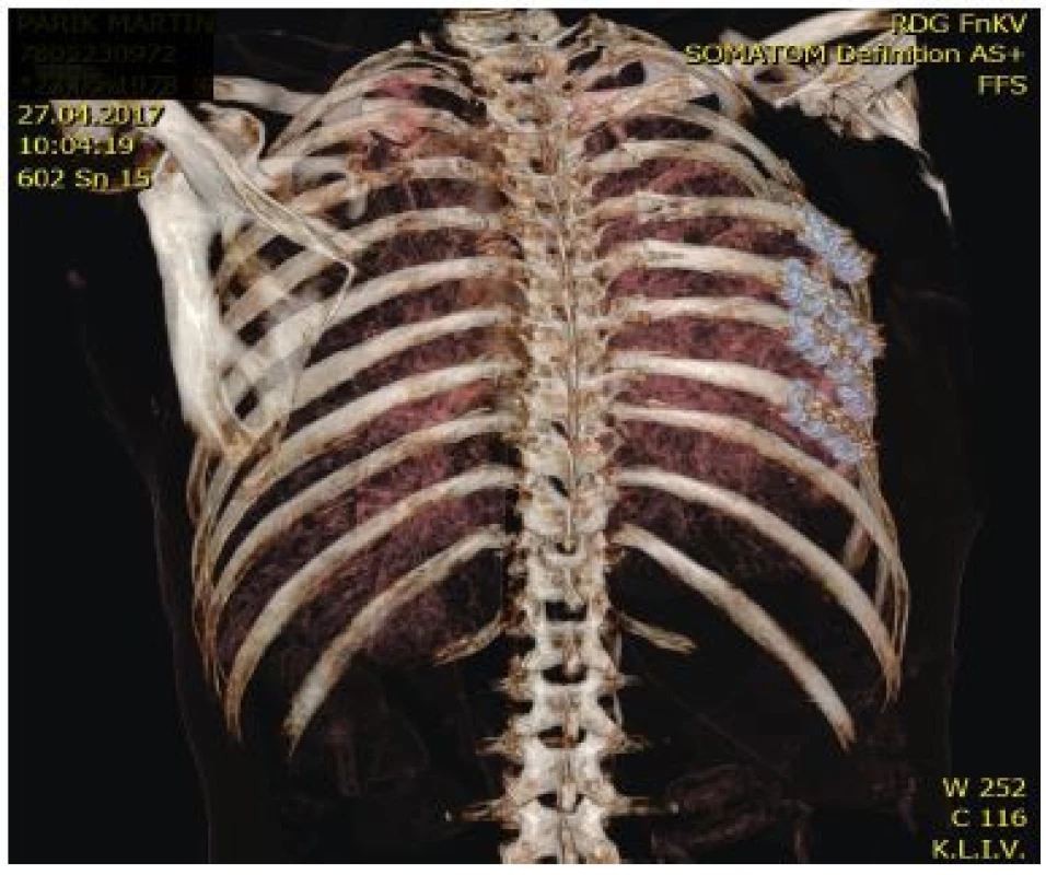 MDCT snímek osteosyntézy čtyř žeber vpravo inovovaným dlahami
Judetova typu