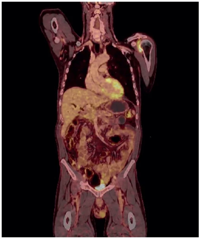 PETCT po neoadjuvanci FOLFIRINOX. Na základě
tohoto byl indikován pokus o radikální výkon <br> 
Fig. 3. PETCT following neoadjuvant therapy with FOLFIRINOX;
a radical procedure was attempted based on this
assessment