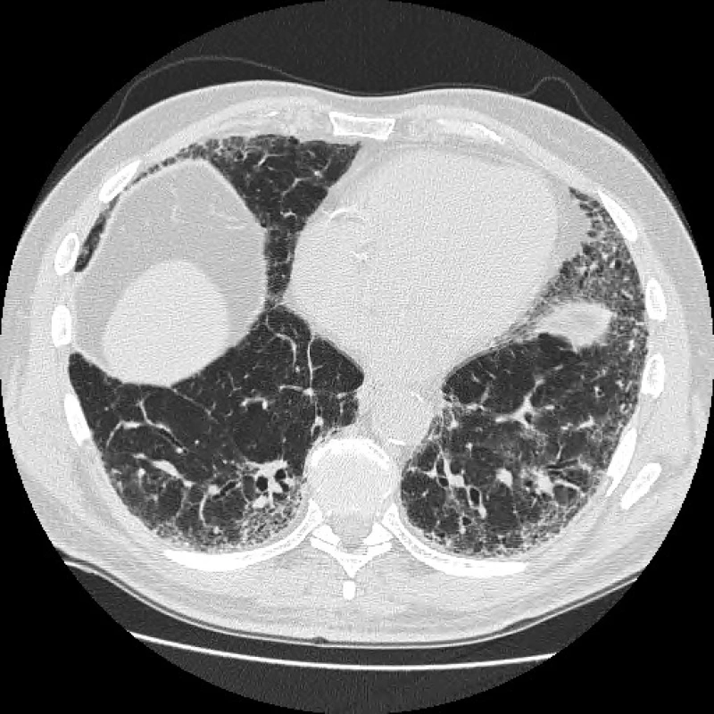 Radiologický obraz pravděpodobné UIP, bez voštinovité
plíce s trakčními bronchiektasiemi