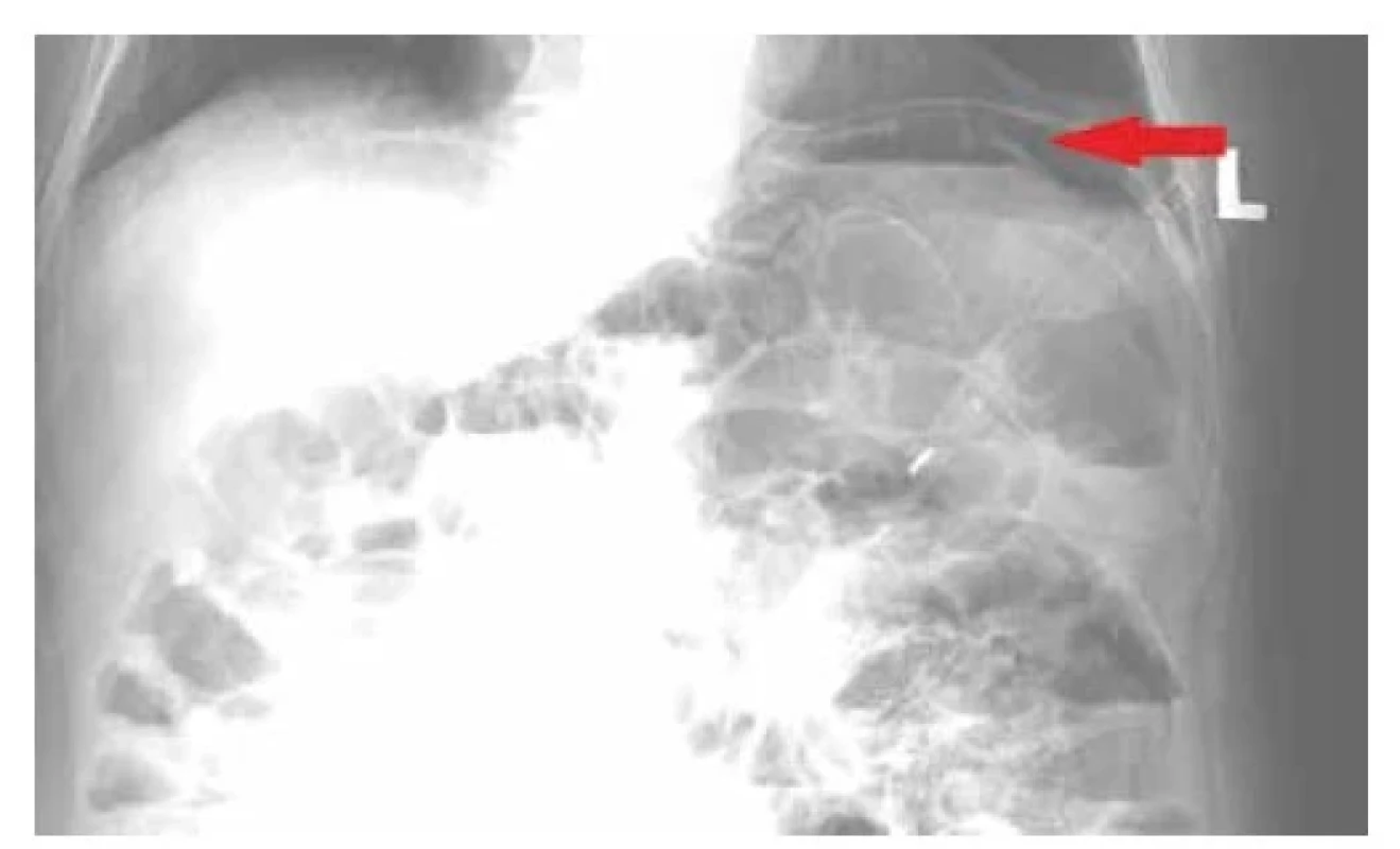 Pneumoperitoneum vlevo subfrenicky<br>
Fig. 1: Pneumoperitoneum in the left subphrenic space