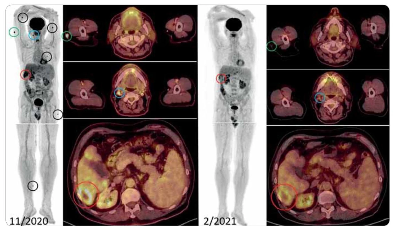 Snímky FDG-PET/CT.