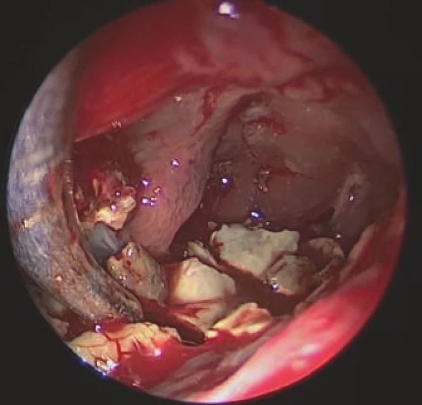 Endoscopic view of the left frontal
sinus via an external approach, revealing
yellowish, hard stone-like fungal masses
inside the cavity.<br>
Obr. 2. Endoskopický pohled z externího
přístupu do levé frontální dutiny, ve které
jsou viditelné nažloutlé, kamenně tuhé,
mykotické hmoty.