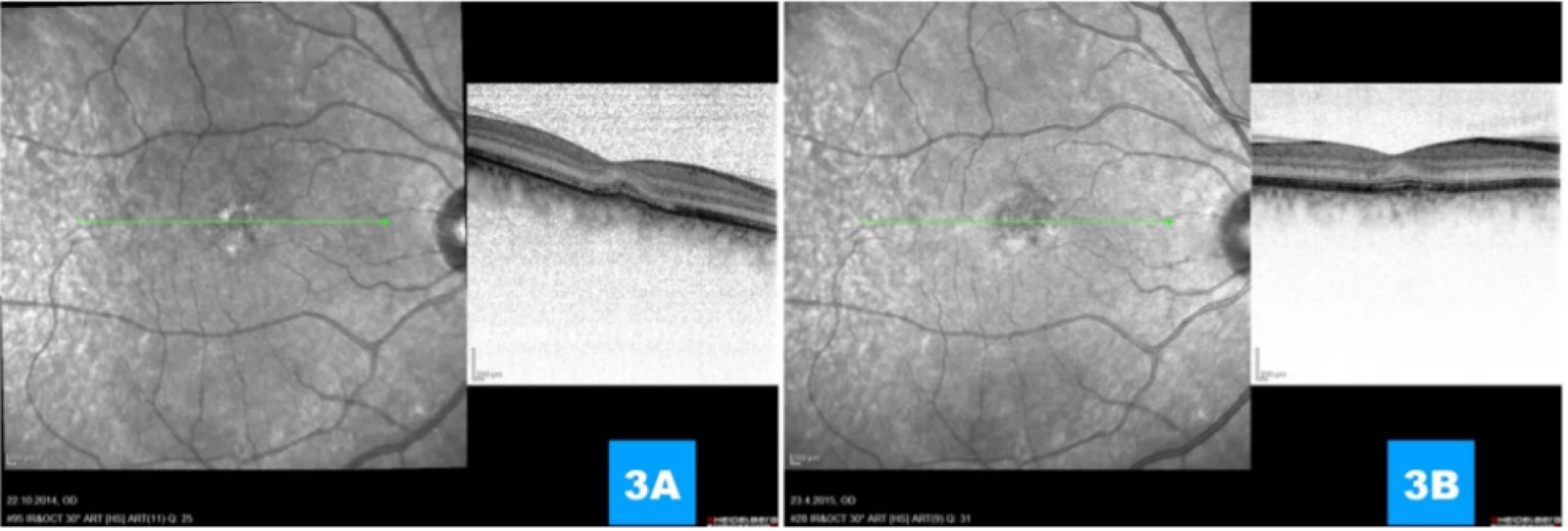  (A, B) Progressive absolute regression of classic portion, regression of subretinal fluid, preservation of membrana limitans
externa, renewal of interdigitation zone and intimation of extirpation of line of retinal pigment epithelium 1 month and 1 year
respectively after application of anti-VEGF agent 