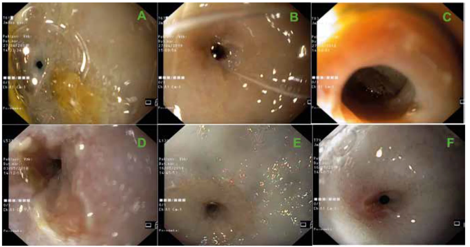 Endoscopic views of stricture sites developed after complete CED during control endoscopies just before necropsy.<br>
Minipigs T61 (A), T67 (B), T83 (C), L531 (D), L139 (E) and T79 (F).