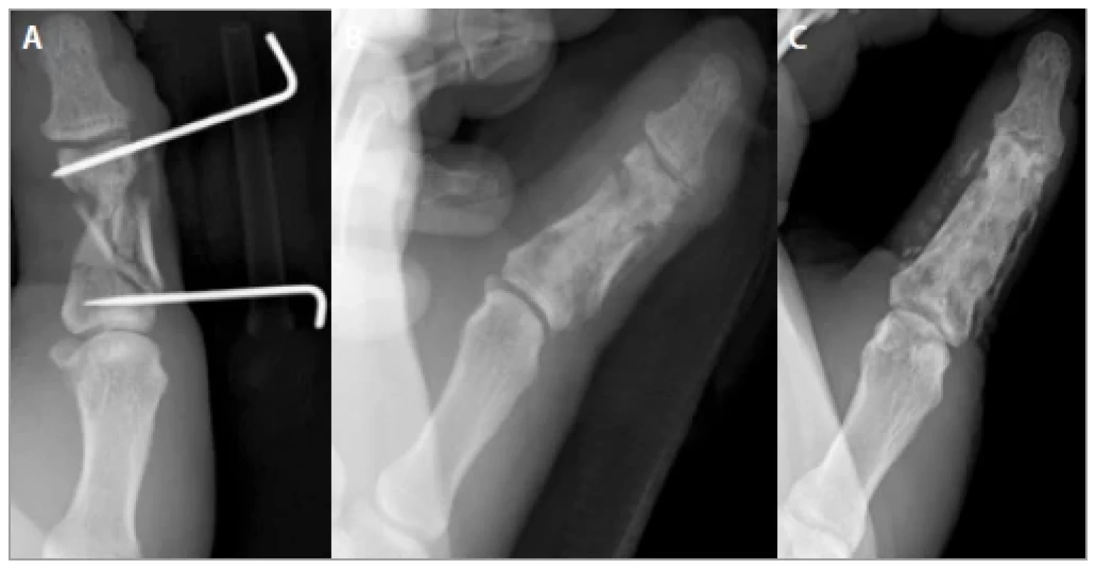 Radiographic evaluation (case 2).  <br> 
A) Preoperative X-ray (posterior-anterior
view), note the malalignment; B) postoperative X-ray (posterior-anterior view), note
the restoration of the anatomical axis; C) postoperative X-ray (posterior-anterior view)
at a 5-year follow-up.