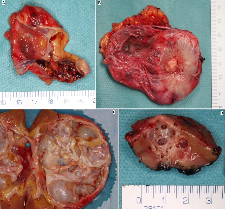 Fotografie preparátů nejčastějších histologických typů (A – CCRC, B – PRCC, C – MESTK, D – MCRNLMP)<br>
Fig. 3. Photos of the most common histological types (A – CCRC, B – PRCC, C – MESTK, D – MCRNLMP)