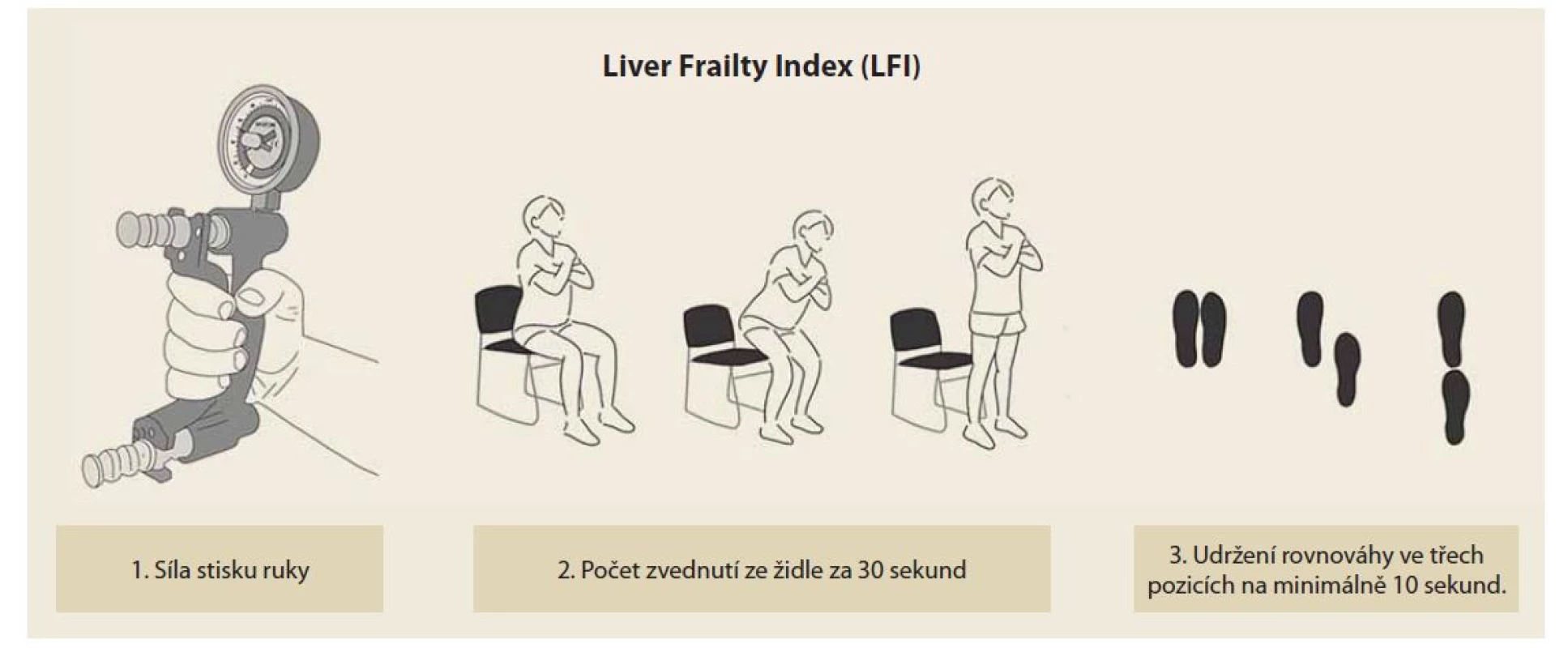 Liver Frailty Index (LFI). Výpočet: (–0,330 x síla stisku ruky dle pohlaví) + (–2,529 x počet zvednutí ze židle
za 30 sekund) + (–0,040 x doba udržení rovnováhy ve třech pozicích) + 6.<br>
Hodnoty vyšší než 4,5 jsou diagnostické pro přítomnost křehkého fenotypu. (Se svolením Kláry Maryníkové.)<br>
Fig. 1. Liver Frailty Index (LFI). Calculation: (–0,330 x hand grip strength according to gender) + (–2,529 x number of lifts from
a chair in 30 seconds) + (–0,040 x time to maintain balance in three positions) + 6.<br>
Values higher than 4,5 are diagnostic for the presence of frailty phenotype. (With the permission of Klára Maryníková.)