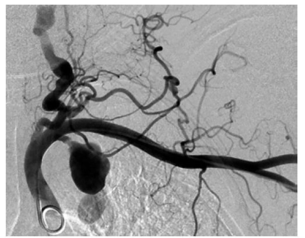 Aneuryzma arteria thoracica interna (AATI)<br>
Fig. 9: Internal mammary artery aneurysm