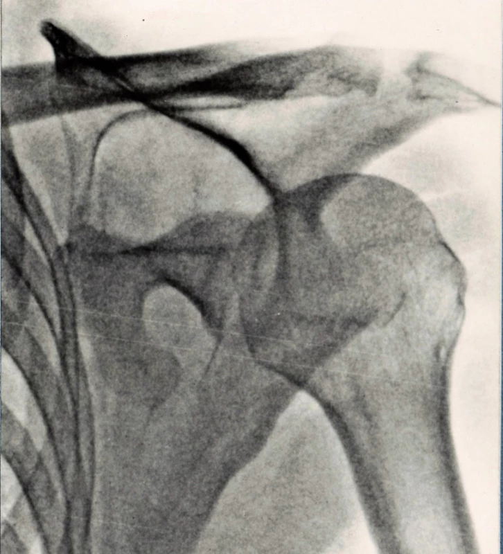 Typical displacement of a totally unstable (rupture
of coracoacromial and coracoclavicular ligaments) fracture
of surgical neck