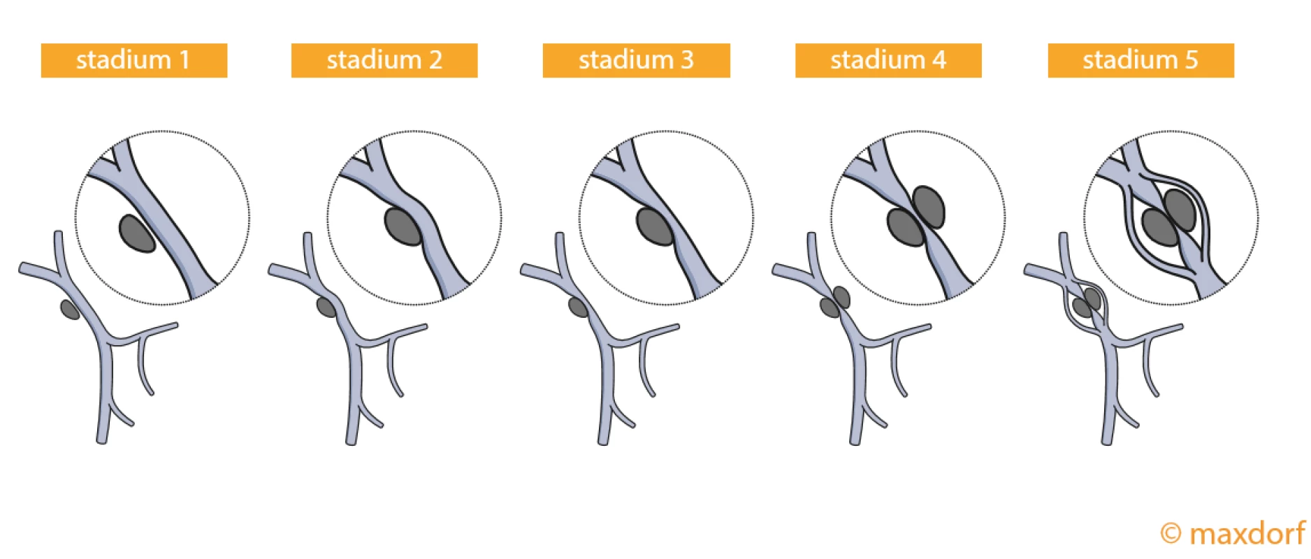 Stadia infiltrace karcinomu pankreatu s portomezenterickou žílou: stadium I – bez kontaktu; stadium II – PMV je odtlačována nádorem; stadium III – PMV je zúžena; stadium IV – nádor prorůstá do lumen PMV; stadium V – nádor uzavírá PMV a jsou patrné kolaterály.