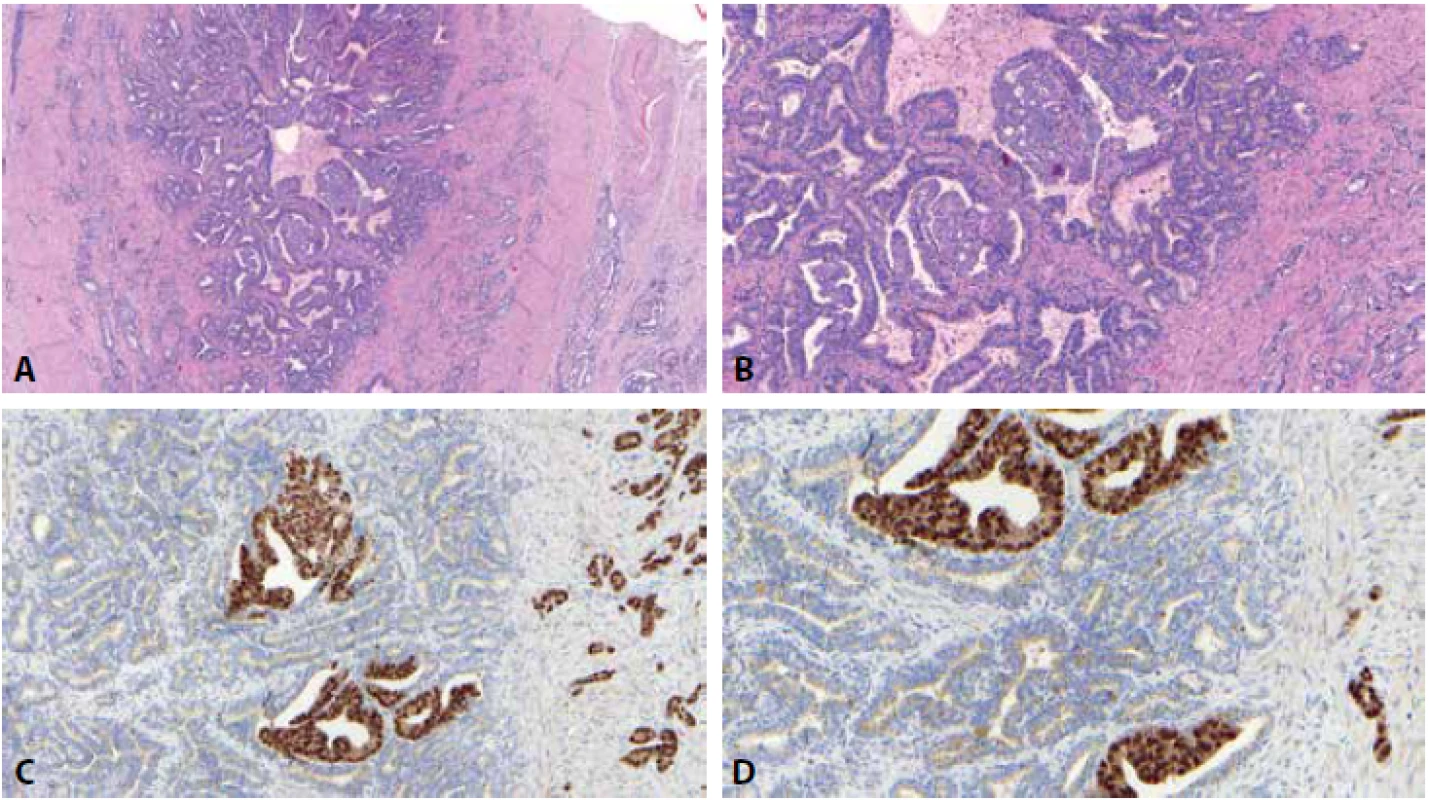 K užití imunohistochemie v rámci lézí semenných váčků nutno vždy přistupovat s obezřetností. V ideálním případě sice může být nápomocná, ideální případy se však v reálné praxi vyskytují relativně s nízkou frekvencí. Většina biopsií, kde by mohla být imunohistochemie nápomocná je totiž většinou miniaturních, zhmožděných a rychle se vykrajuje, literární data o užití vhodných imunohistochemických markerů jsou často protichůdná. Zde je zastižen ideální případ, kde vidíme infiltraci chámovodu adenokarcinomem prostaty, nádor kolonizuje epitel a infiltruje stěnu, vidět je perineurální propagace nádorových struktur v měkkých tkáních v okolí chámovodu (A, B). Nádor je NKX3.1 jasně jaderně pozitivní, naopak epitel semenných váčků je NKX 3.1 negativní (C). V imunohistochemických řezech je pak jasně vidět charakteristický zlatavý pigment (D), který může někdy velmi výrazně interferovat s imunohistochemickým barvením a např. při použití PSA a jeho cytoplasmatické pozitivity může
v imunohistochemických řezech způsobit až falešnou pozitivitu barvení.