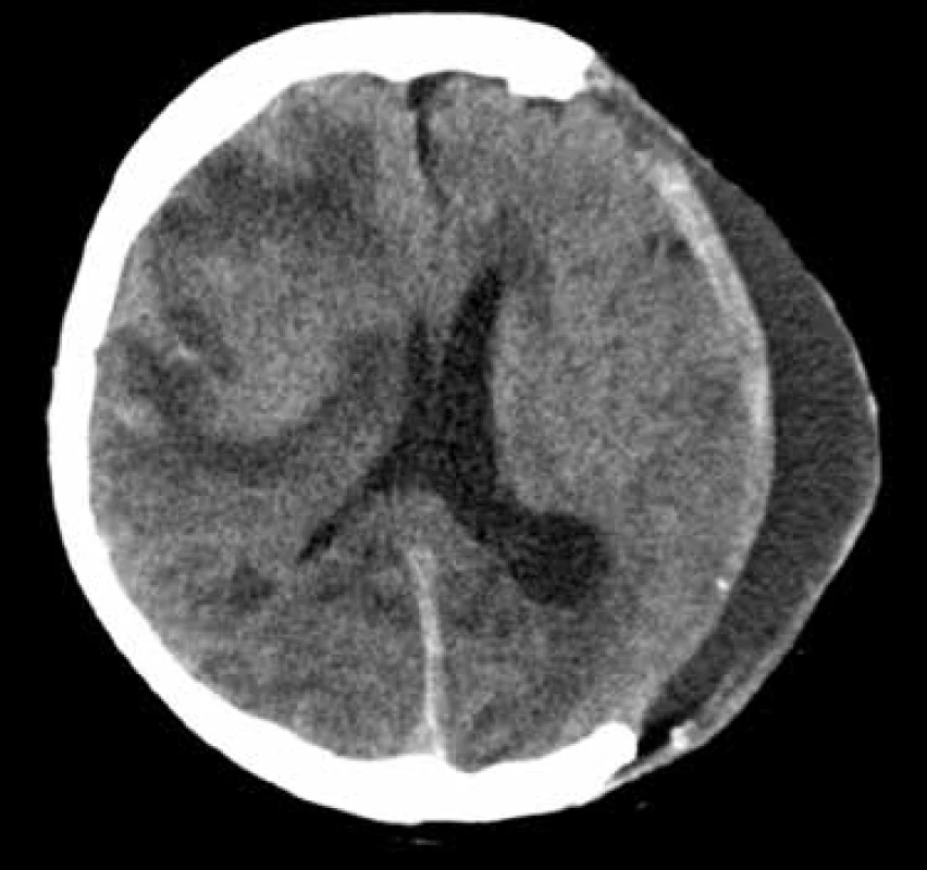 Subgaleální likvorová kolekce<br>
Fig. 3: Subgaleal cerebrospinal fluid effusion