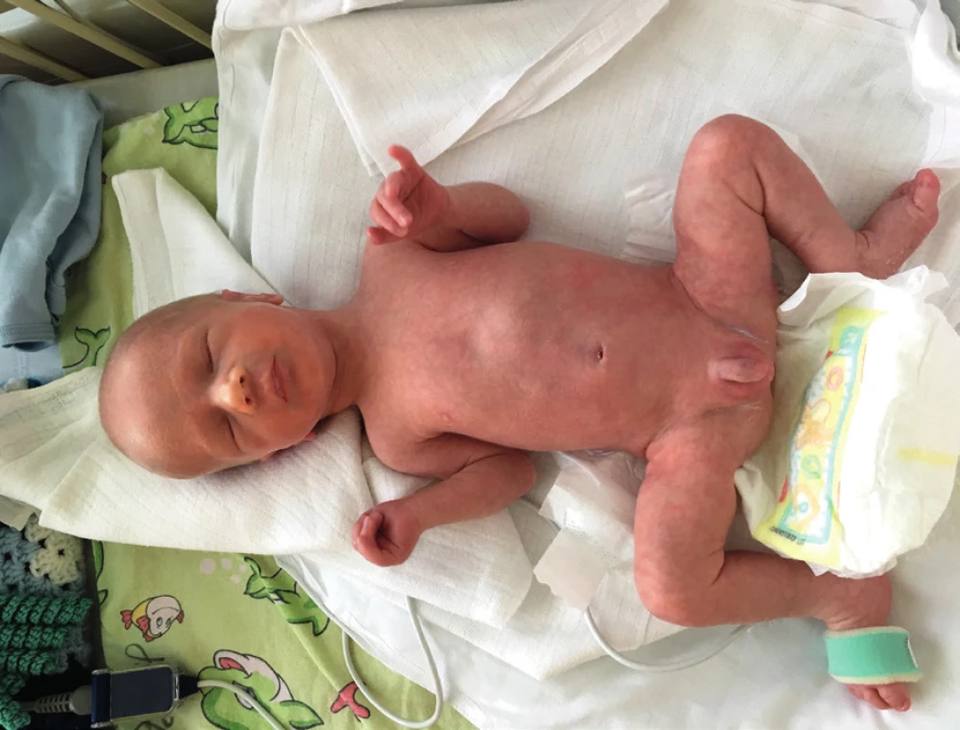 Obojstranný kryptorchizmus u novorodenca
s Praderovej-Williho syndrómom.<br>
Fig. 1. Bilateral kryptorchidism in newborn with Prader-Willi
syndrome.