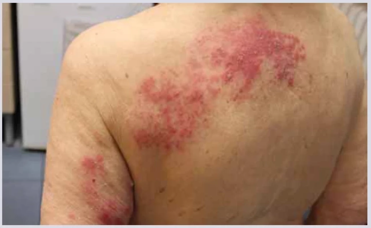 Herpes zoster. ,br> 
Fig. 4. Shingles.