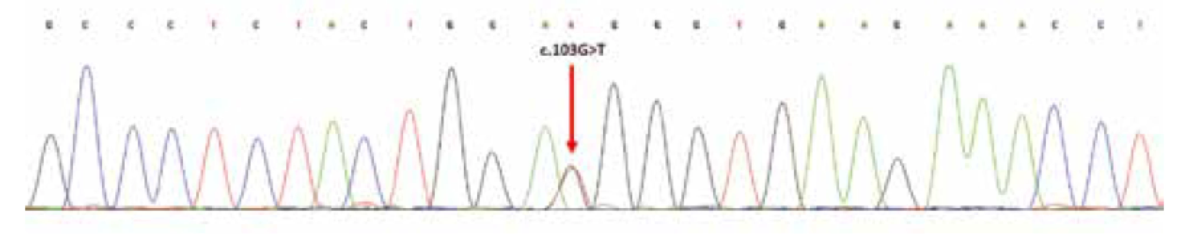 Sekvenční analýza exonu 2 genu
H3F3A; šipka označuje heterozygotní substituční
mutaci v pozici c.103G>T; resp.
náhradu aminokyselin glycin za tryptofan
(p.Gly35Trp; dle původního označení G34W).