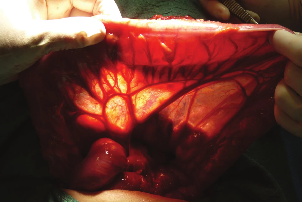 Zhodnocení stavu
příčného tračníku – viditelné
větvení a. colica media,
anastomosis magna a a. colica
sinistra<br>
Fig. 1: Assessment
of transverse colon status –
visible branches of medial
colic artery, anastomosis
magna and left colic artery
