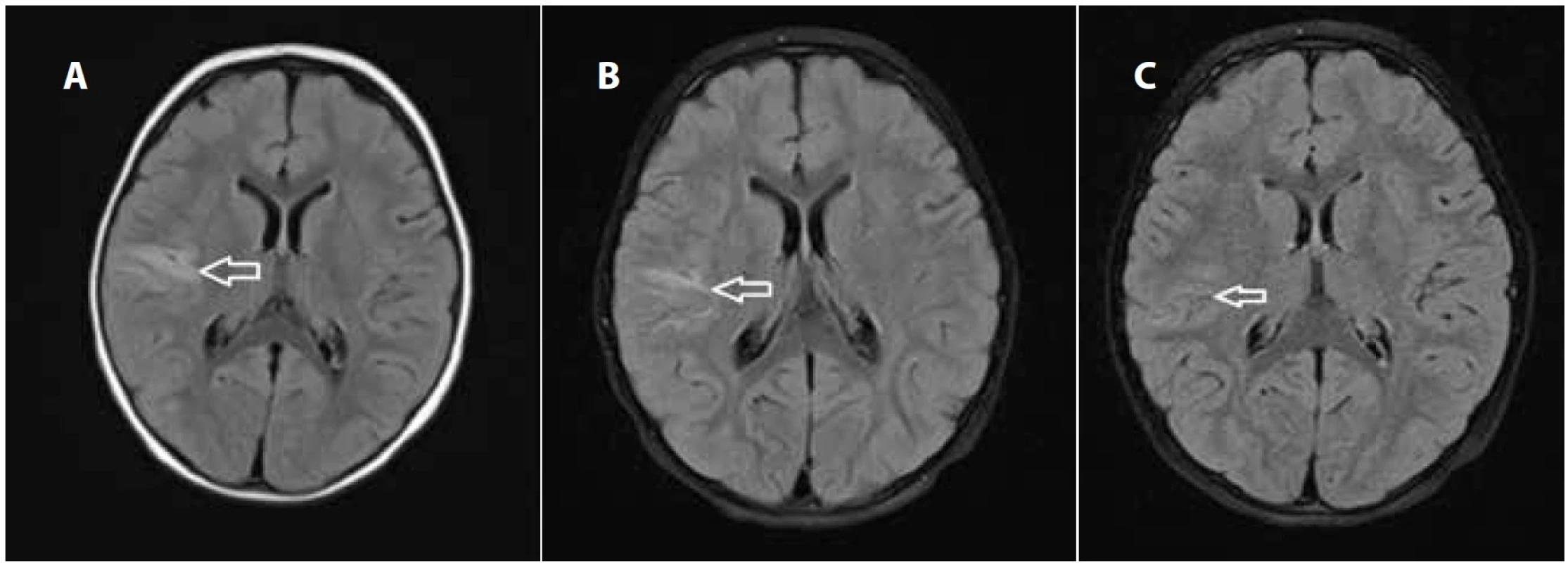 Magnetická rezonance, T2 Flair skeny: a) vstupní – axiálně s T2 hypersignálním lemem juxtakortikálně až kortikálně na rozhraní
gyrus frontalis inferior a gyrus temporalis superior vpravo; b) za 2 týdny s přetrváváním edému; c) za 4 měsíce s diskrétními
reziduálními gliotickými změnami v místě původní ischémie.
Fig. 2. Magnetic resonance imaging, T2 Flair axial scan: a) initially T2 hypersignal area juxtacortically to cortically at the interface of
the inferior frontal gyrus and the superior temporal gyrus on the right side b) after two weeks with the persistence of oedema and
gliosis; c) after four months with discrete residual gliotic changes at the site of the original ischemia.