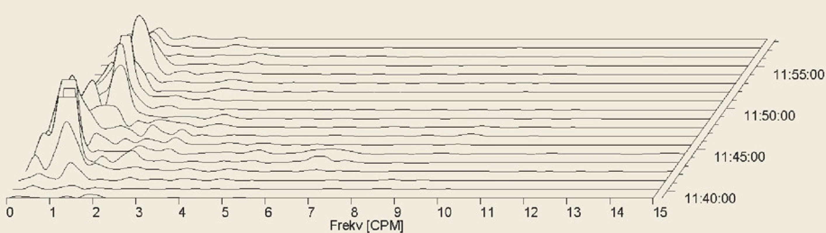 Electrogastrography. Fourier transform. Postprandial bradygastria in a patient with systemic sclerosis.<br>
Elektrogastrografi e. Fourierova transformace. Postprandiální bradygastrie u pacienta se systémovou sklerodermií.