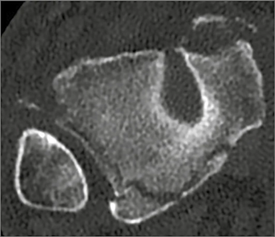 Komprese subchondrální kosti v oblasti incisura fibularis
tibiae doprovázená zlomeninou Chaputova hrbolu a zadního
malleolu typu 2<br>
Fig. 11. Compression of the subchondral bone in the region of
the fibular notch, associated with a fracture of the Chaput tubercle
and of the posterior malleolus, type 2