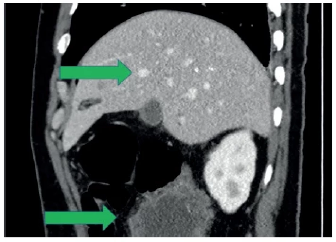Stagingové CT vyšetření, boční rekonstrukce
Viditelné metastázy jater a tumorózní masa v oblasti colon
ascendens (zelené šipky). <br> 
Fig. 3. Staging CT scan, lateral reconstruction
Visible liver metastases and tumor mass in the area of the colon
ascendens (green arrows).