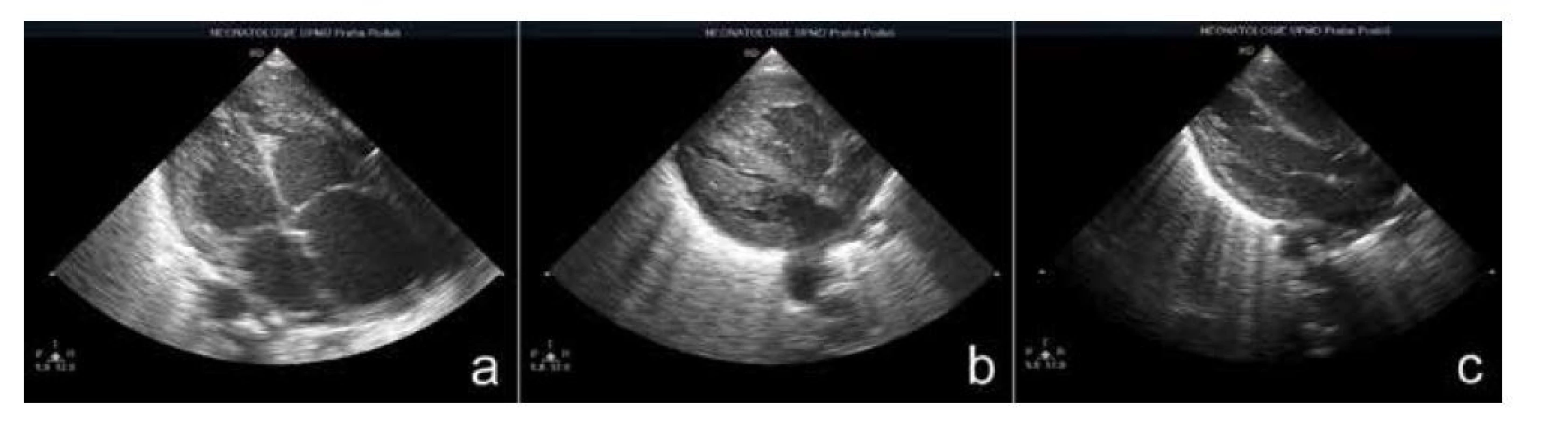 Echokardiografie u pacienta s hydropsem a těžkou fetální anemií: a – čtyřdutinová projekce 1. den života, městnavé srdeční
selhání; b – čtyřdutinová projekce 7. den života, hypertrofie myokardu; c – dlouhá osa 39. den života, normální nález