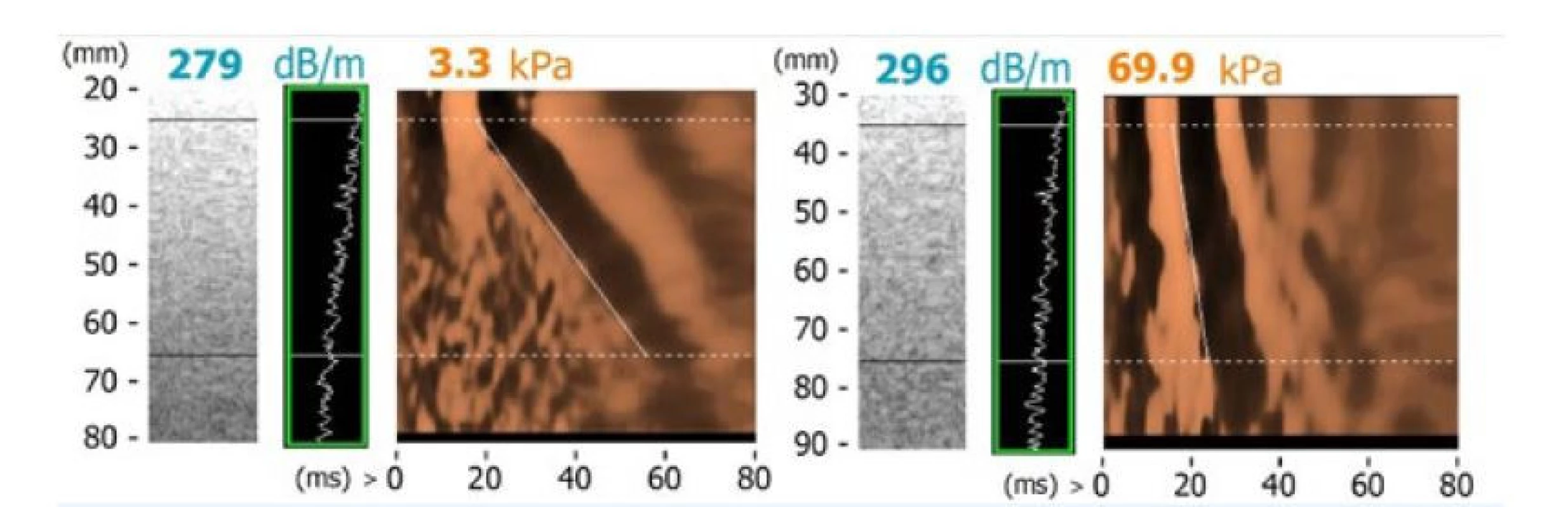 Měření přístrojem FibroScan: vlevo normální tuhost jater, vpravo cirhotická játra.