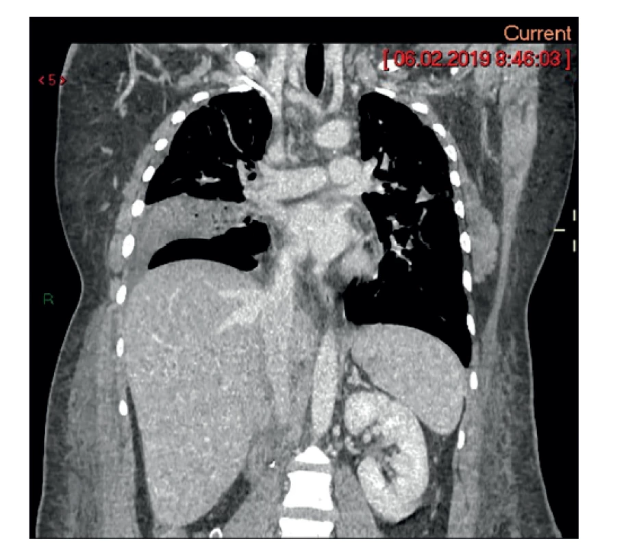 Pooperačný stav – pľúcnica a dolná dutá žila bez
embolu<br>
Fig. 5: Postoperative condition – pulmonary artery and
inferior vena cava without the embolus