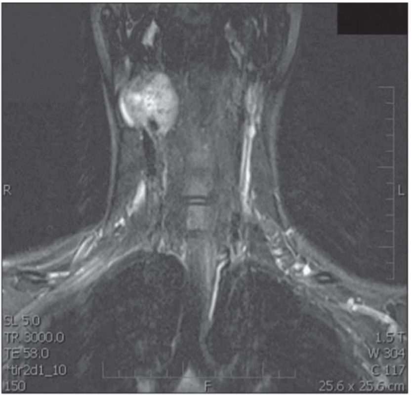  T1-weighted MRI scan, after administration of gadolinium, demonstrates a mass within the right carotid space. Both
the external carotid artery and the internal carotid artery are
constricted.<br>
Obr. 1. T1-vážený obraz MR po podání gadolinia. Viditelná masa
karotické prostoru vpravo zaujímající a. carotis externa a interna.