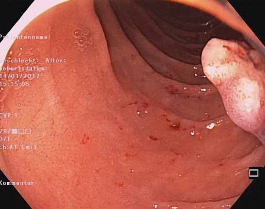 EGD – rezíduum polypu po polypektómii.<br> Fig. 7. EGD – reasidual polyp after polypectomy.