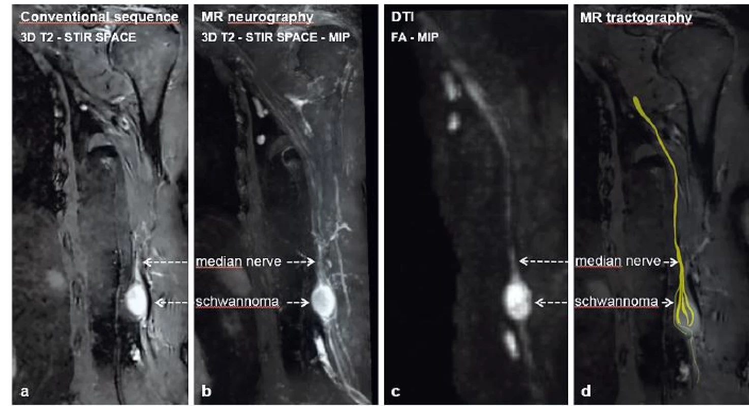 Median nerve schwannoma showed using (a) conventional MRI sequence – 3D T2–STIR SPACE, (b) MRN–3D T2–STIR SPACE–MIP
reconstruction, (c) DTI–FA–MIP reconstruction and (d) MRT
DTI= diffusion tensor imaging; FA= fraction anisotropy; MIP= maximum intensity projection; MRN= MR neurography; MRT= MR
tractography; SPACE= sampling perfection with application optimized contrast using varying flip angle evaluation; STIR= short tau
inversion recovery; T2= T2 weighted images
