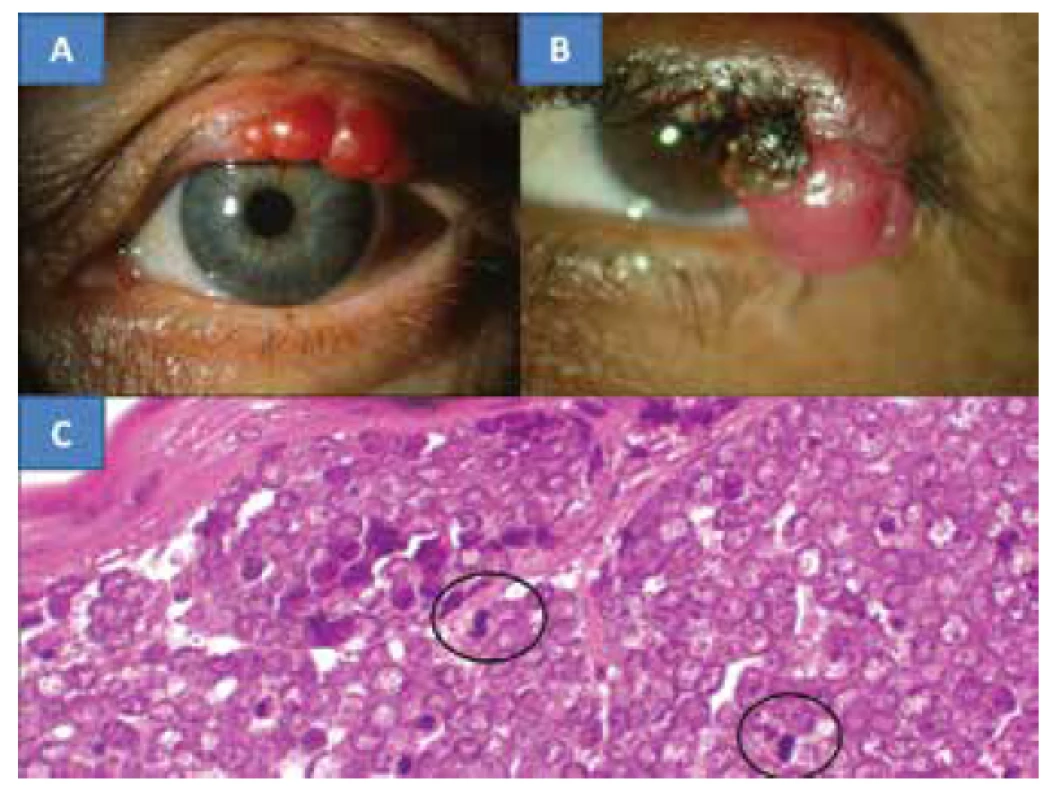 MCC víčka u 78leté pacientky (A), MCC víčka u 67leté
pacientky (B), Charakteristický histologický nález MCC je tvořený
oválnými, nondendritickými, epidermálními čirými buňkami
s mitózami – označeny kroužkem (C), barvení HE, zvětšení 300x