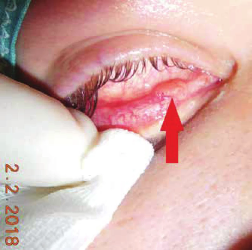 Clinical picture of a patient with papilloma of conjunctiva on
the inner side of lower eyelid