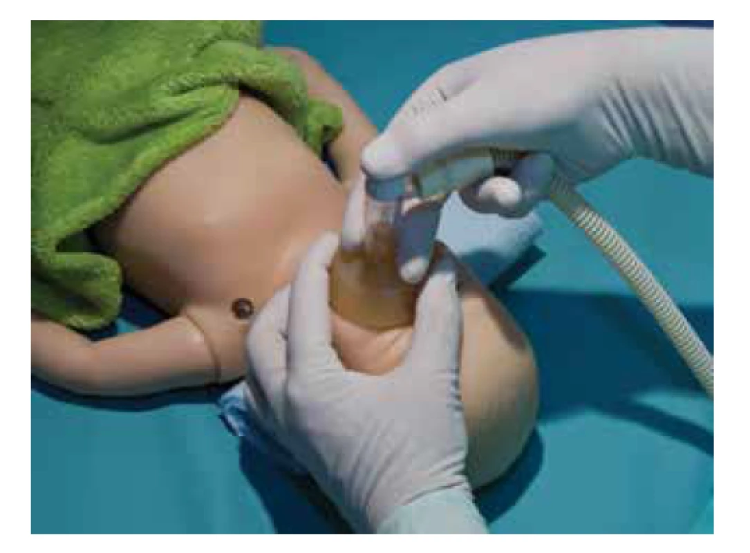 Ventilace přes obličejovou masku (T spojka).<br>
Fig. 5. Facemask ventilation (T-piece).