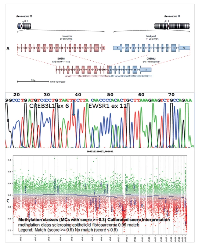 A: Diagnostikovaný fúzní gen EWSR1-CREB3L1 u dětské pacientky se sklerotizujícím epiteloidním fibrosarkomem. Analýza pomocí Arriba
software https://github.com/suhrig/arriba. B: Sekvenační analýza fúzního produktu EWSR1-CREB3L1 pomocí Sangerovy sekvenace. C: Metylační
analýza pomocí metylační SNParray.