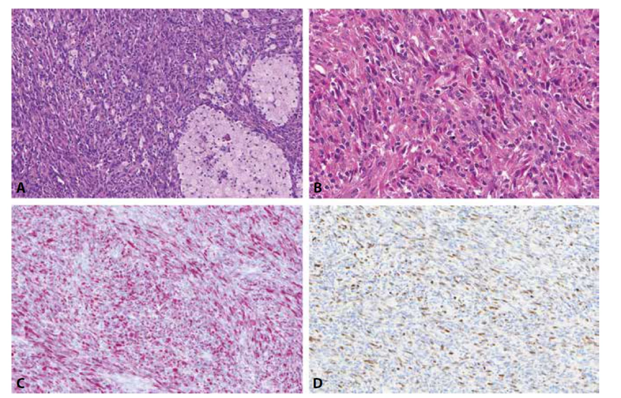 Low-grade inflamatorní myogenní tumor je typicky složený z vřetenitých, místy epiteloidních až rhabdoidních buněk a je nápadný svou
výraznou inflamatorní příměsí ve formě disperzně rozesetých lymfocytů a prominentních histiocytárních agregátů (A, B). Tento tumor může exprimovat
jak desmin (C), tak MyoD1 (D), myogenin či PAX7 (nezobrazeno).