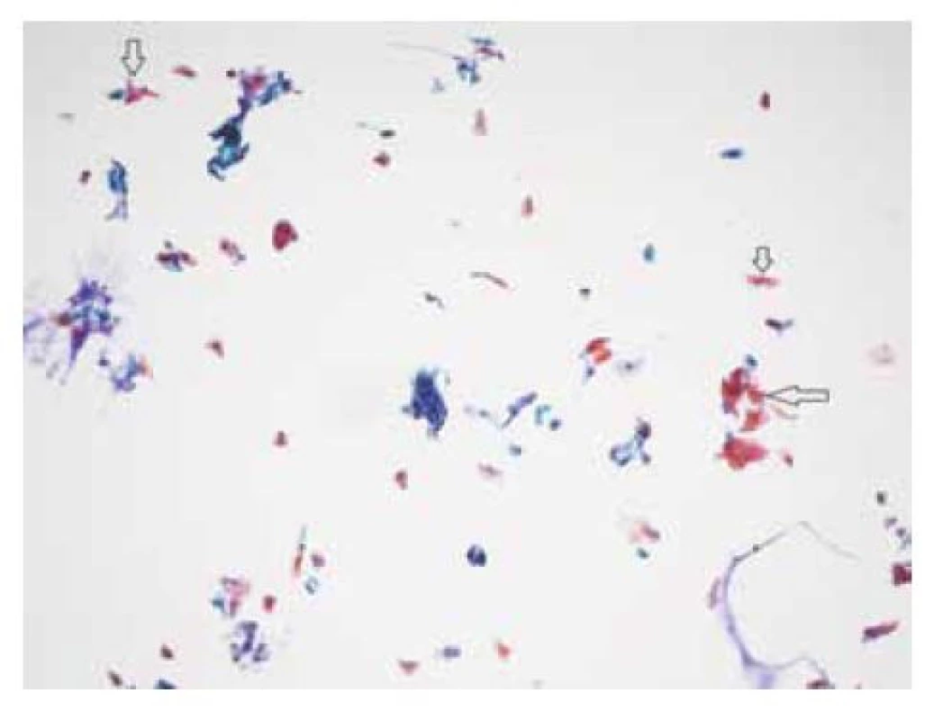 NILM (negativní pro intraepiteliální lézi a malignitu) –
obecně jsou anální cytologické LBC (liquid-based cytology)
nátěry méně buněčné než cervikální LBC<br>
Keratotické šupinky (šipky) jsou často hojně přítomny.<br>
(barvení podle Papanicolaou, zvětšení 200x)