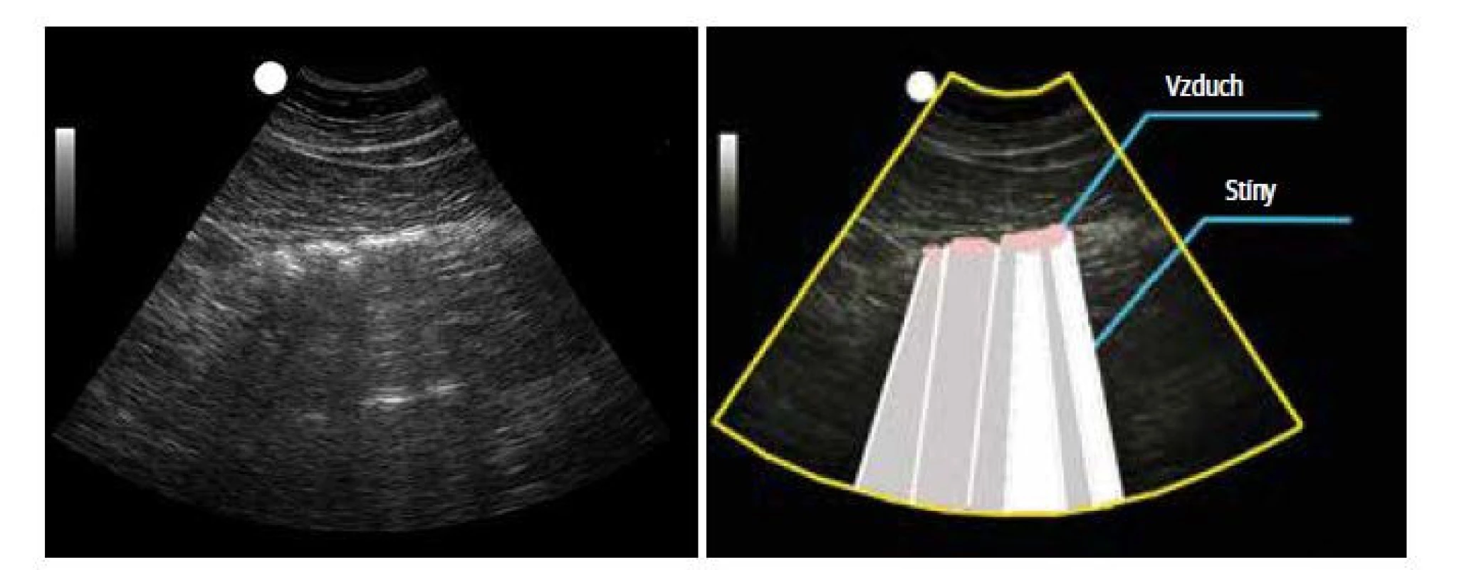 Vzduch v colon transversum bránící zobrazení anatomických struktur za ním; a) sonografický
snímek, b) kresba.