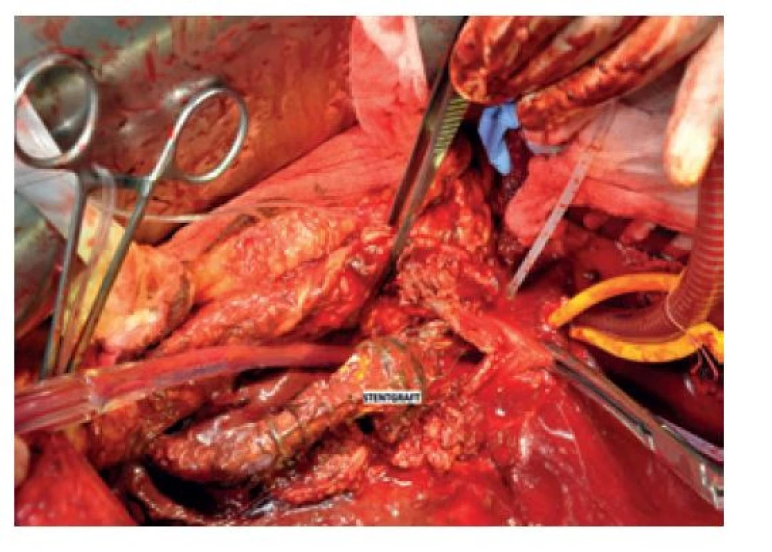 Explantace stentgraftu<br>
Fig. 7: Stent-graft explantation