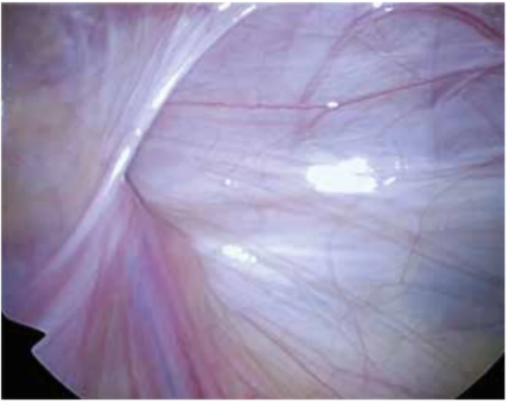 Otevřený pravý anulus inguinalis profundus<br>
Fig. 4: Open right anulus inguinalis profundus