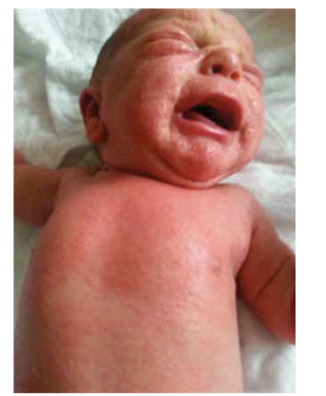 Erytrodermia u pacienta s Omennovým syndrómom
(pacient č. 12).<br>
Fig. 3. Erythroderma in patient with Omenn syndrome (patient
12).