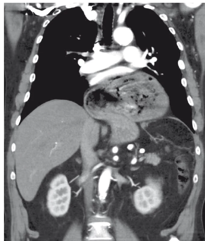 CT břicha, koronární rovina, k.l.i.v. – objemná axiální hiátová hernie žaludku,
bez detekce volvulu.<br>
Fig. 1. Abdominal contrast enhanced CT scan, coronal plane, intravenous contrast
dye – a large axial hiatal hernia of the stomach, without detection of volvulus