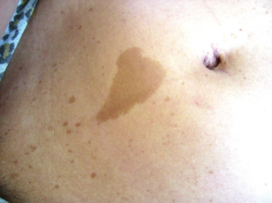 Café-au-lait<br>
Source: Paediatric Clinic, Faculty of Medicine, Masaryk
University and University Hospital Brno