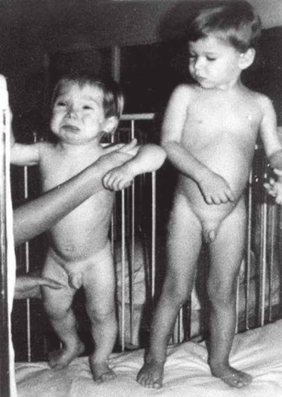 Batole s neléčenou vrozenou hypotyreózou ve 2 letech věku ve srovnání se zdravým dítětem (z archivu prof. MUDr. Olgy Hníkové, CSc.).<br>Fig. 4. Untreated case of congenital hypothyroidism at the age of 2 years, compared with a healthy child (provided by prof. MUDr. Olga Hníková, CSc.).